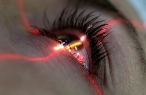 Почему после лазерной коррекции расплывчатое зрение