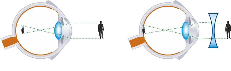 как видит при близорукости 