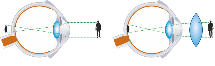 как видит при дальнозоркости