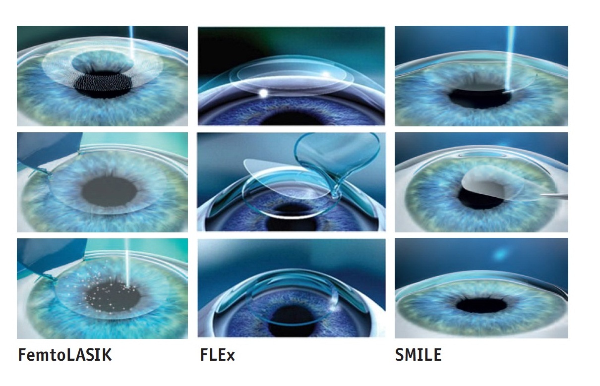 Коррекция зрения сравнение. Фемто ласик лазерная коррекция. Коррекция зрения Фемто ласик. Ласик (LASIK)/Фемто ласик (Femto LASIK).