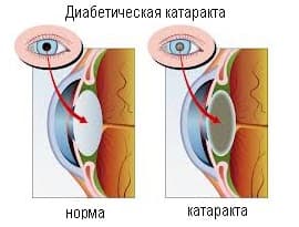 Диабетическая катаракта симптомы