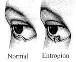 Entropion causes