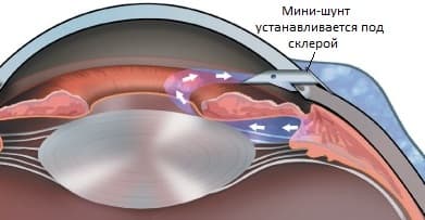 Лечение глаукомы новейшими разработками в Красноярске!