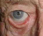 Eyelid envertion treatment