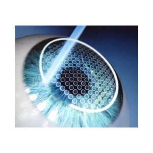 femto lasik flap