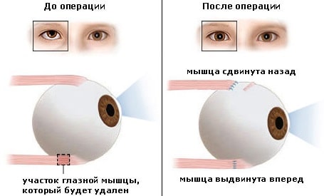 Как выполняется хирургическая коррекция косоглазия