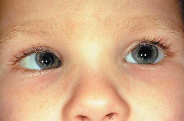 Strabismo infantile