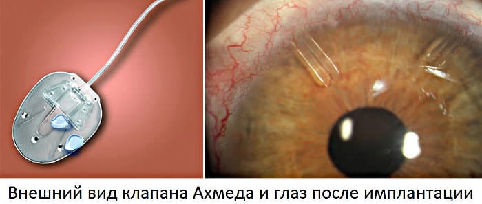 Отзыв врача об имплантации клапана Ахмеда при глаукоме
