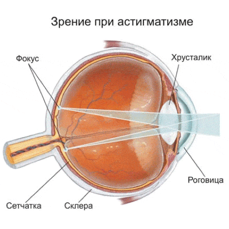 astigmatizm1