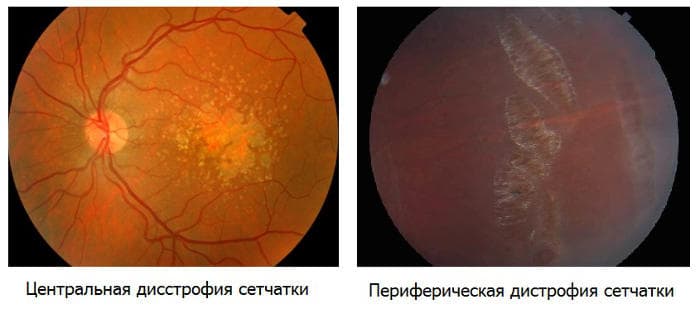 Дистрофии сетчатки глаза - центральные и периферические