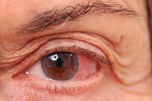 glaucoma mgkl