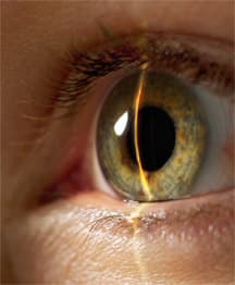 glaucoma mgkl1