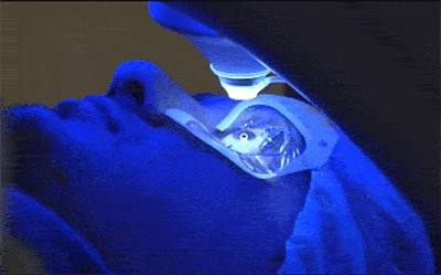 chto takoe lasik2