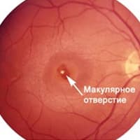 Макулярное отверстие