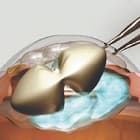 Интракапсулярная экстракция катаракты (ИЭК) c имплантацией ИОЛ
