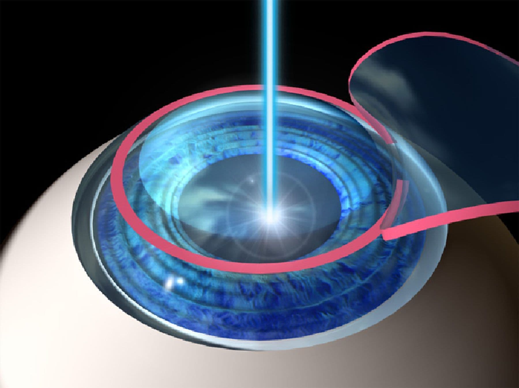 lasik