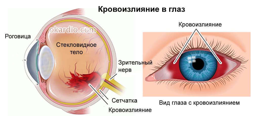 Субконъюнктивальное кровоизлияние