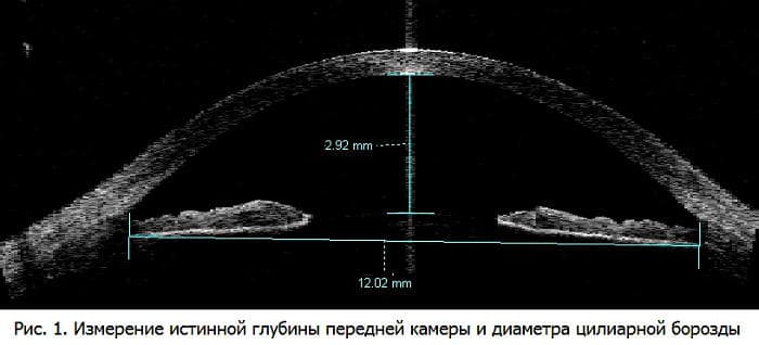 Оптическая когерентная томография передней камеры глаза