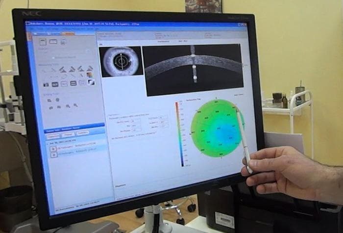 Оптическая когерентная томография роговицы глаза (ОКТ) при кератоконусе
