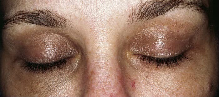 Заболевания кожи вокруг глаз и век. Диагностика и лечение
