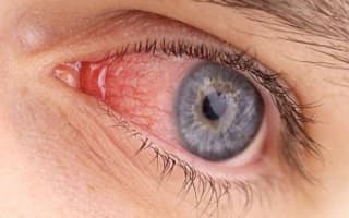 Почему краснеют глаза у человека: основные причины и рекомендации