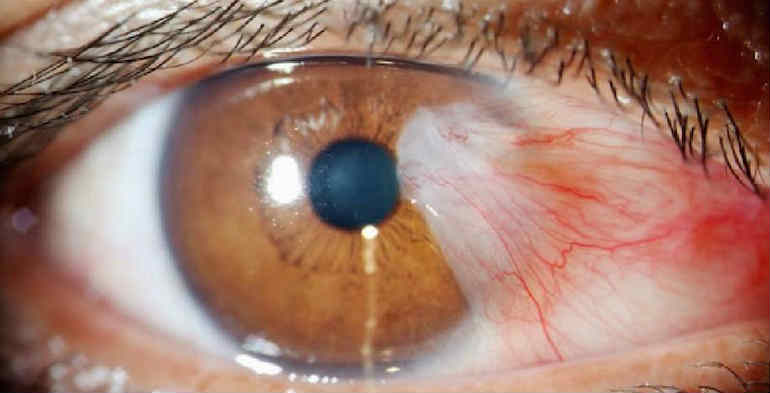 pterigium nf