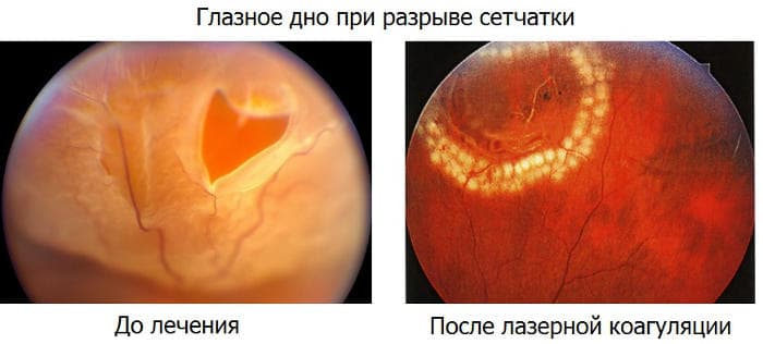Фотография глазного дна при разрыве сетчатки - до и после лечения