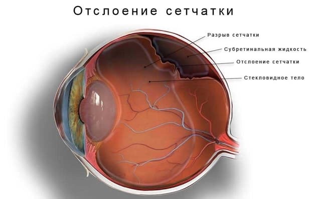Можно ли восстановить отслоившуюся сетчатку глаза? - Полезные рекомендации  от МГК