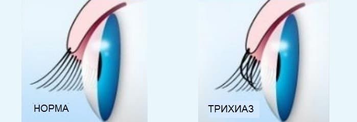 Трихиаз века