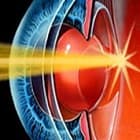 YAG - лазерная дисцизия вторичной катаракты