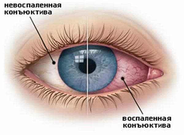 Гиперемия конъюнктивы глаза