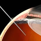 Intravitreal injection