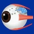 Клапан Ахмеда при глаукоме