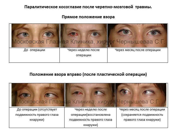 Восстановление зрения после инсульта в Москве