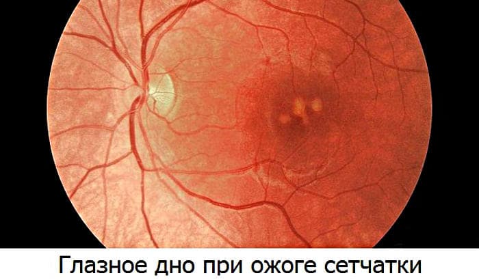 Какие капли для глаз можно использовать при оказании первой помощи?