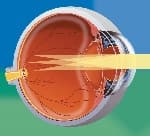 Astigmatism symptoms and causes