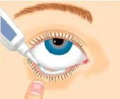 Conjunctivitis treatment