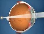 Farsightedness (hyperopia)