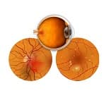 Diabetic retinopathy 