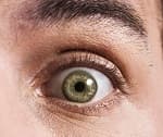 Corneal dystrophy
