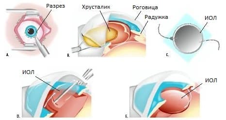 Экстракапсулярная экстракция катаракты операция
