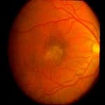 Epiretinal membrane symptoms