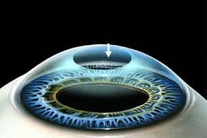 PRK (photorefractive keratectomy)