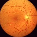 Ангиопатия сетчатки глаза: симптомы, причины, лечение