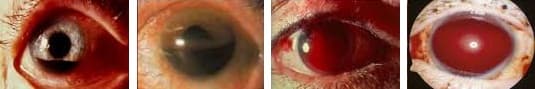 Гифема глаза симптомы