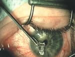 Удаление инородного тела глаза