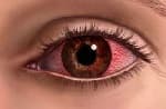 Keratitis of eye cornea
