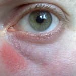 Красные пятна под глазами (вокруг глаз) - причины и лечение