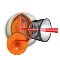 Retina Laser treatment