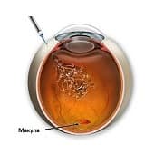 Treatment of Age-related macular degeneration